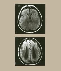 ภาพ MRI เปรียบเทียบสมองของผู้สูงอายุปกติ